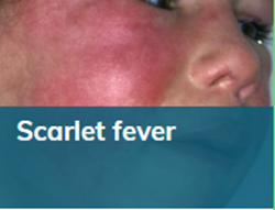 Scarlet fever thumbnail.png