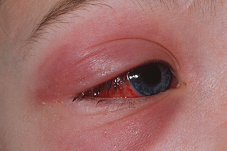 link to cellulitis page
