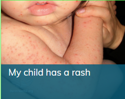 My child has a rash thumbnail.png