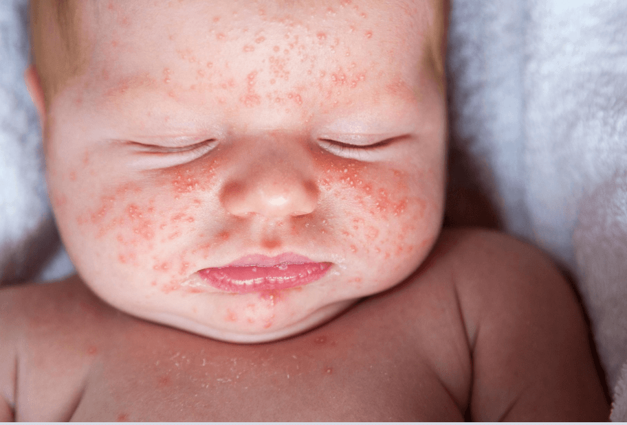 Image of baby with erythema toxicum