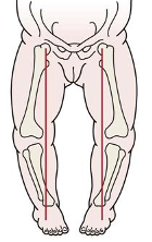 Genu Varum (Bow leg)