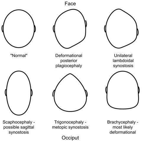 Babies abnormal headshapes