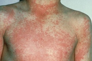 Scarlet Fever body rash.jpg