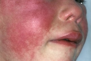 Scarlet Fever Face Rash.jpg