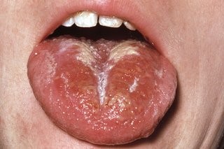 White Coating on Tongue.jpg