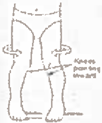 Femoral anteversion image