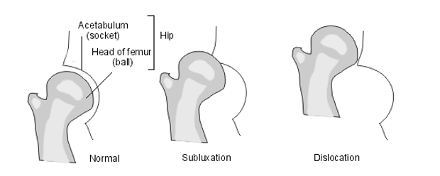 Hip joint - normal, subluxation and dislocation