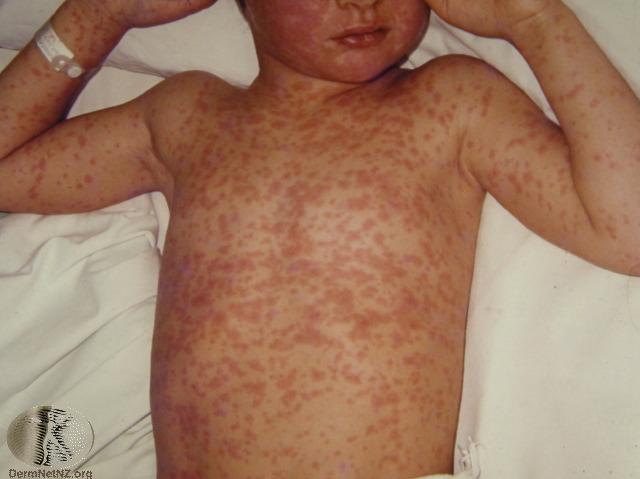 Measles rash.jpg