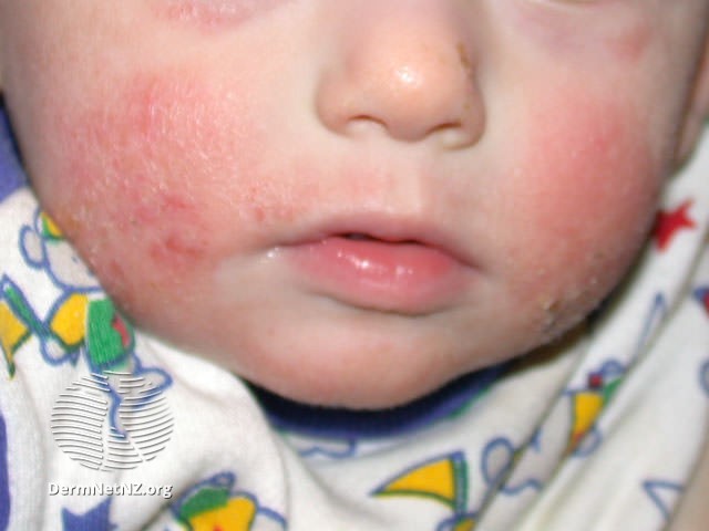 Eczema Rash.jpg