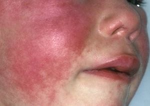 Scarlet Fever Face Rash.jpg