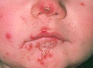 Impetigo blisters on mouth.jpg