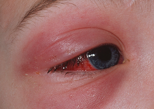 Cellulitis showing in child's eye