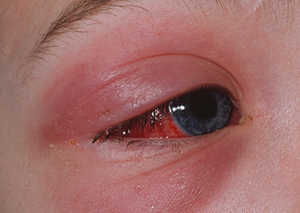 Cellulitis - eye.png