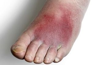 Cellulitis showing on child's foot