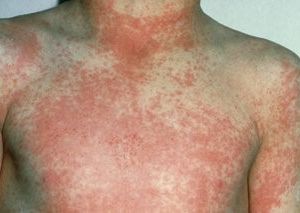 Scarlet Fever body rash.jpg