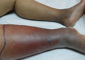 Cellulitis showing on child's leg, black skin
