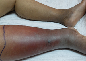 Cellulitis - Leg.png