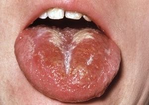 White Coating on Tongue.jpg